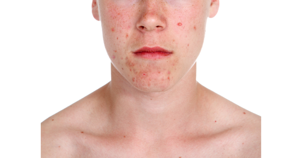 Teenage boy with acne