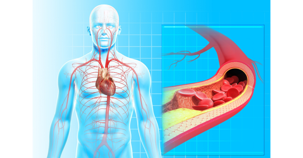 Arteriosclerosis